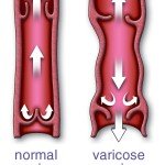 vein-flow-schematic